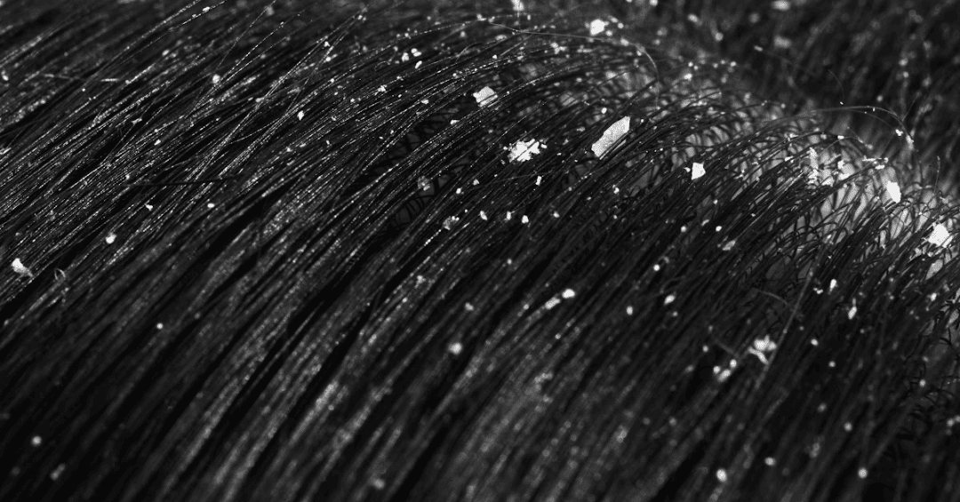 How To Get Rid Of Dandruff In 4C Hair Curls And Cocoa how-to-get-rid-of-dandruff-in-4c-hair-curls-and-cocoa